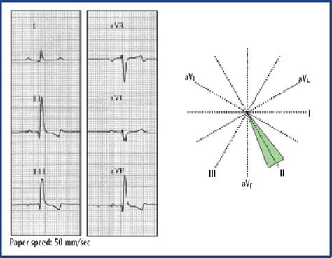 mean electrical axis lab questions